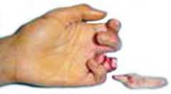 Ring finger (le doigt d'alliance), ou le dégantement du doigt chez un  musicien - édecine des arts