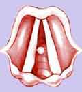 Polype des cordes vocales