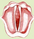 Vergeture des cordes vocales