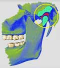 Articulation temporo-mandibulaire