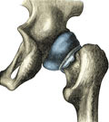 Coxarthrosis of the hip in dancer and dancer